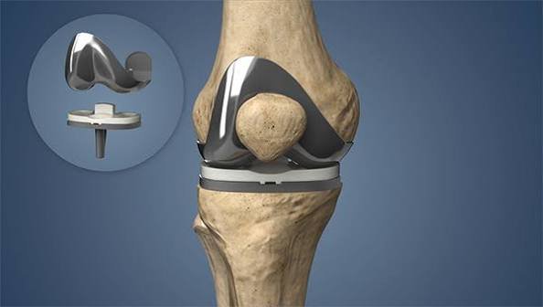 Knee Replacement