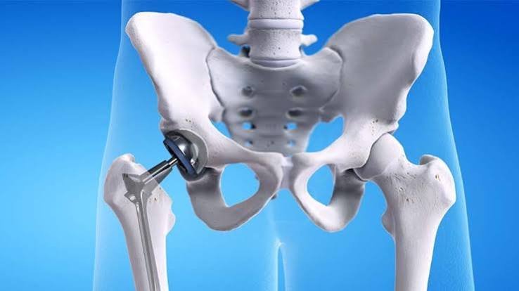 Hip Replacement 