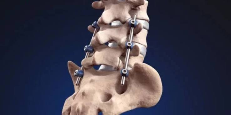 Spinal Fusion Surgery