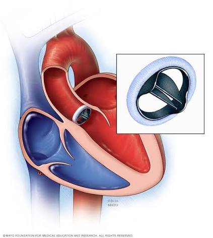 Heart Valve Replacement