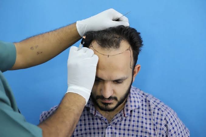 Hair Transplant (FUE)